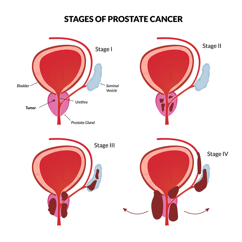 Prostate Cancer as related to Cancers - Pictures