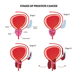 Prostate Cancer Diagram
